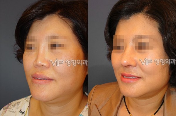 	Harmony-Rhinoplasty, Protruded Mouth Correction Rhinoplasty, Rib cartilage Rhinoplasty	 - Revision- correction of depressed nose with Rib cartilage